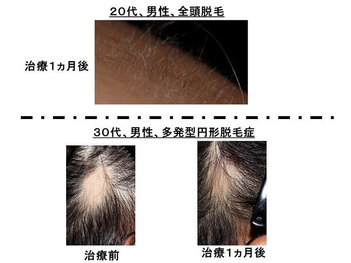 円形脱毛症　病院